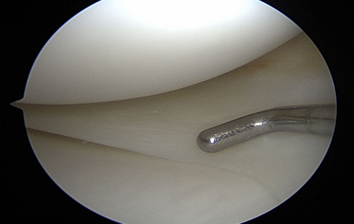 Menisco sano medial en rodilla derecha - Dr. Aldo Bauza especialista en cirugía de rodilla